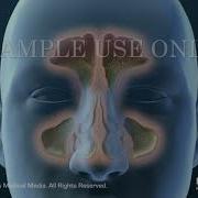Sinusitis Surgery Nucleus Medical Media