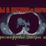 Саркоидоз Легких Кт