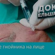 Удаление Огромного Гнойника На Лице